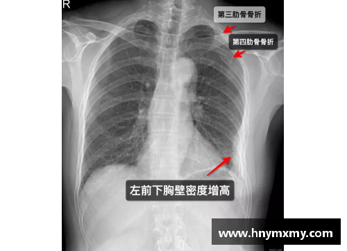 球员肋骨骨折：运动场上的隐形伤痛
